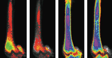 Images of bones stained with osmium. Left: bone fat decreased due to exercise. Right: bones of mice on high dose of rosiglitazone. Far right image shows decrease in bone fat due to exercise.