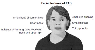 This image depicts the facial features of fetal alcohol syndrome (FAS). Source: National Institute on Alcohol Abuse and Alcoholism (NIAAA).