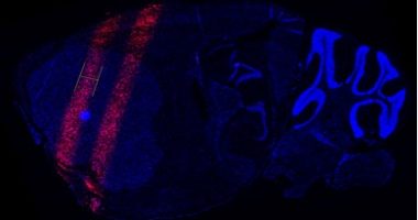 Microbeam radiation therapy doses the area with thin parallel planes of radiation