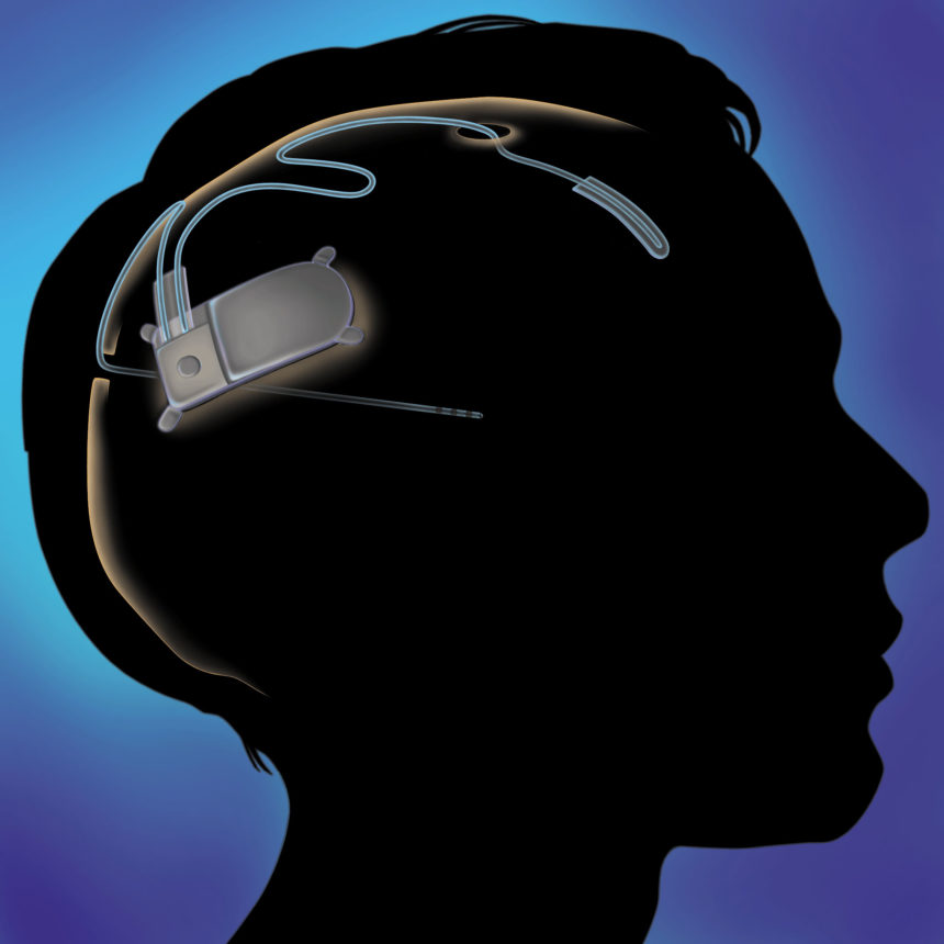 Illustration of RNS Device courtesy of NeuroPace