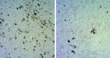 Angiosarcoma cells treated with a monoclonal antibody targeting SFRP2 (right) show a significant reduction compared to an untreated control (left).