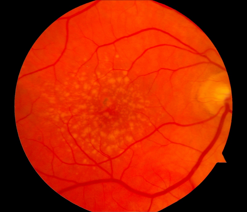Photograph of a macula (the highly sensitive center of the retina) with intermediate age-related macular degeneration.
