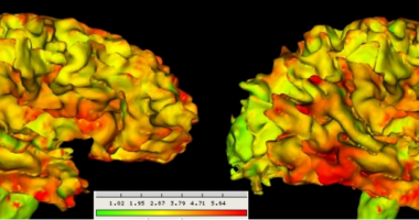 These images show brain maturation measured by cortical thickness for a representative subject with autism at age 2 (left) and age 4 (right). Thicker areas of cortex are shown in red