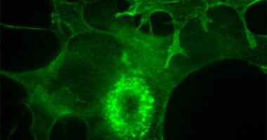 Dot-like invadopodia assemble into circular groups known as “rosettes” inside cancer-associated fibroblasts (CAFs) grown from a human pancreas tumor. CAFs utilize palladin-containing invadopodia to help the cancer cells move across tissue boundaries.