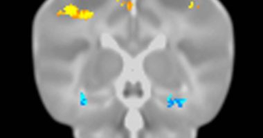 Impact of the APOE Alzheimer’s risk variant on the newborn brain. Blue clusters show decreased brain volumes in newborns with the risk variant. Similar decreases in this brain area