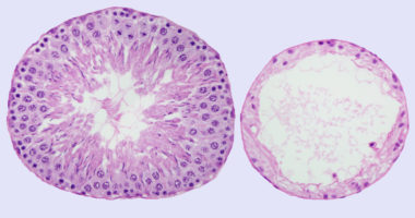 The testis is composed of many tubes called “seminiferous tubules.” The seminiferous tubule on the left is from a testis that was not treated with ultrasound while the tubule on the right is from a testis that was treated with ultrasound.