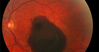 Subretinal hemorrhage in a wet macular degeneration patient.