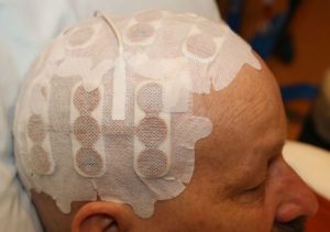 patient wearing an Optune device