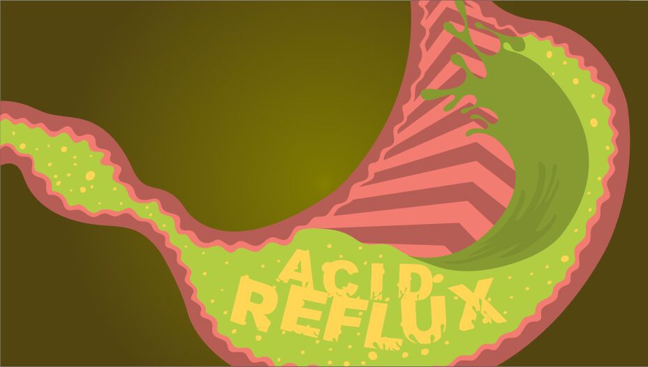 Acid reflux and chest pain sore throat