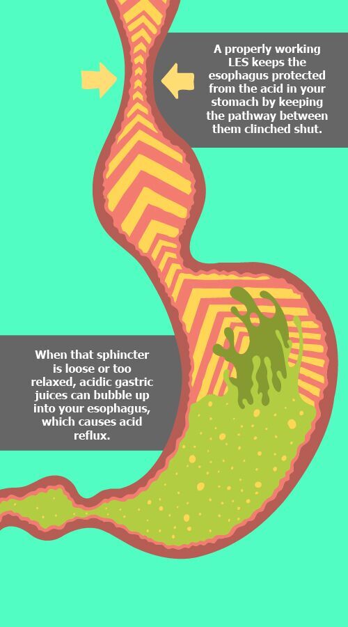 Acid Reflux infographic