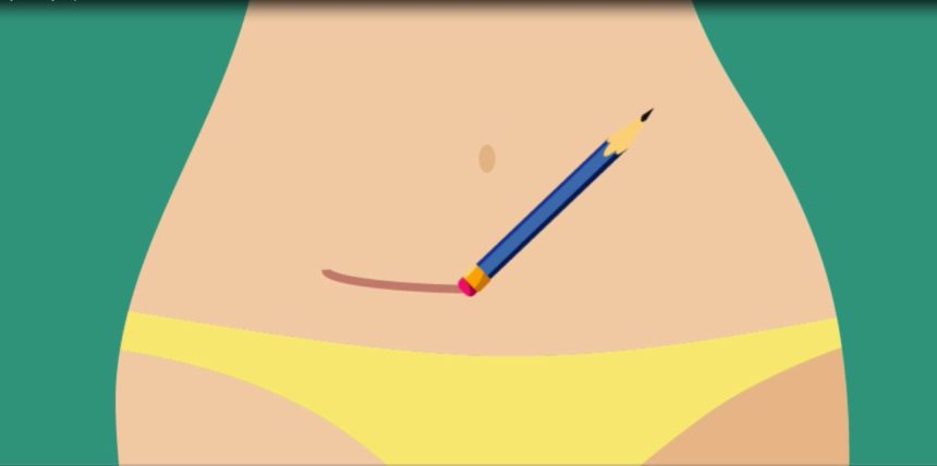 Cartoon of erasing a scar from a hysterectomy