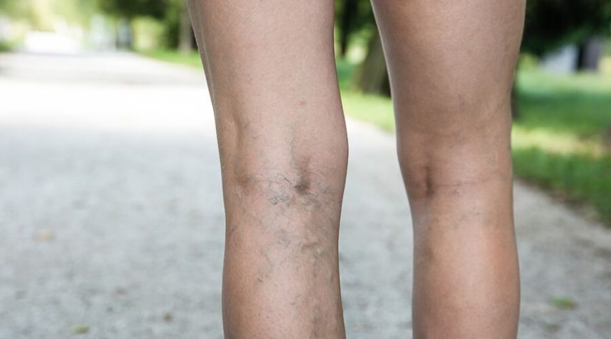 Close up of back of legs with spider veins