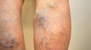 Before & After Photos of Varicose Vein Treatments