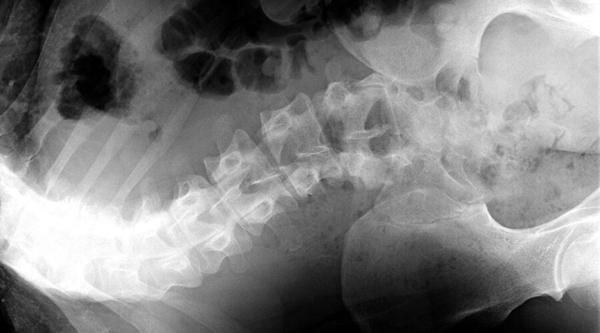 x-ray of curved spine