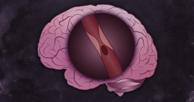 graphic of a microscopic view of blood clot in a pink brain