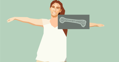 A woman with an illustration of her bone scan.