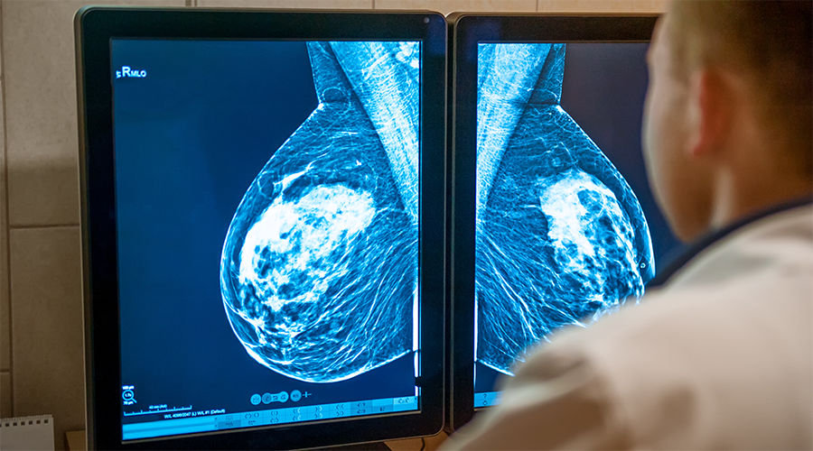 Breast Density and Its Effect on Your Cancer Screening