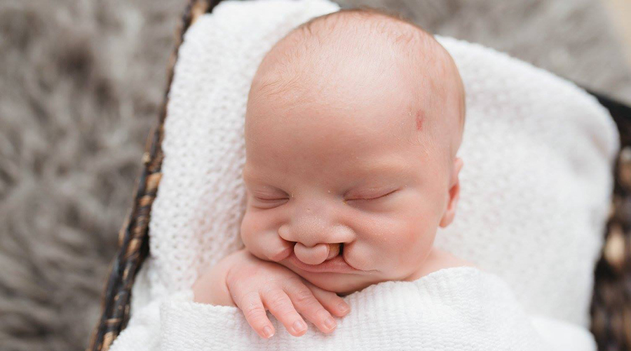 Newborn baby with cleft lip and palate
