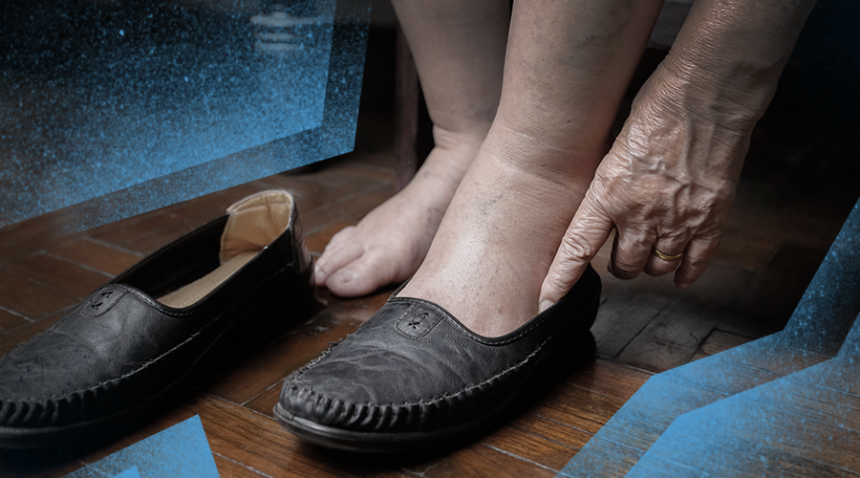 elderly person putting shoes on swollen feet