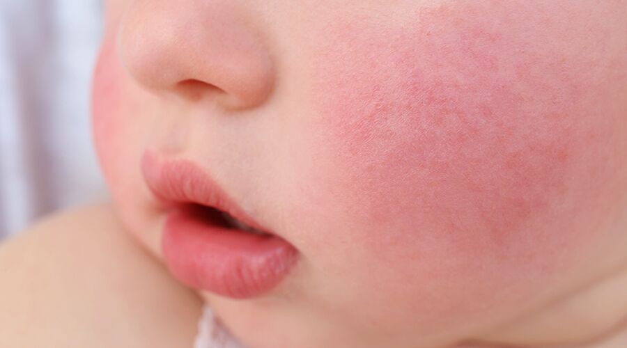 Does Your Child Have Fifth Disease UNC Health Talk