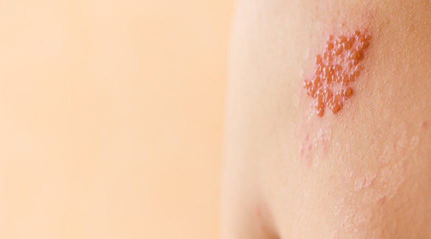 A photograph showing the health condition called Shingles.