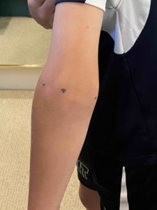Photo of Batten's swollen elbow