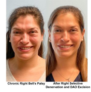 Before and after photo of UNC Patient smiling after being treated for Bell's Palsy