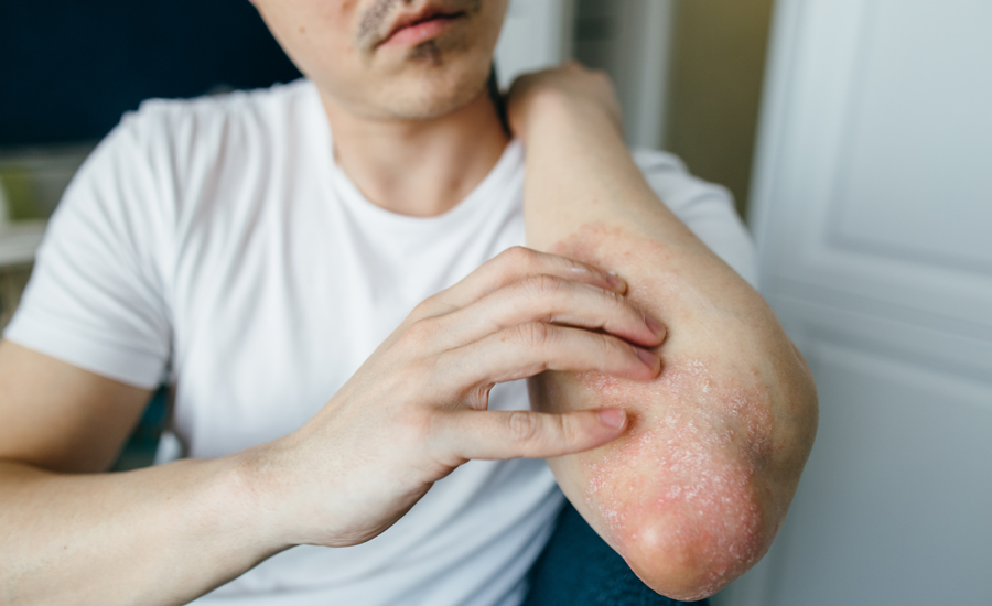 Close up view of a man scratching his elbow, which has psoriasis on it