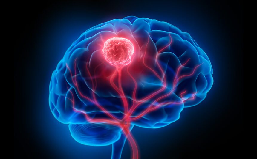 medical illustration of a brain with a red tumor inside the brain