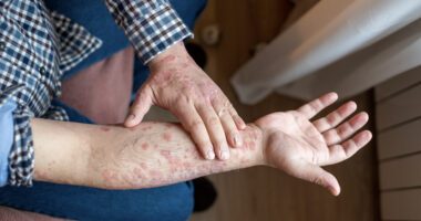 A person with red, scaly patches on their arms, possibly from a skin condition like eczema or psoriasis, applying cream for relief.