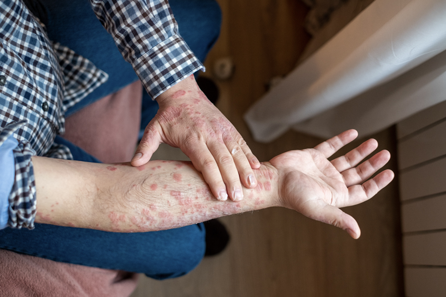 A person with red, scaly patches on their arms, possibly from a skin condition like eczema or psoriasis, applying cream for relief.