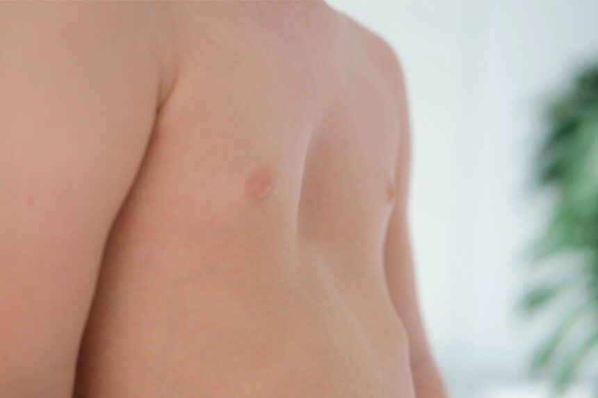 Image of a child's chest with Pectus Excavatum