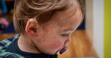 small child with pacifier, with measles rash on his face