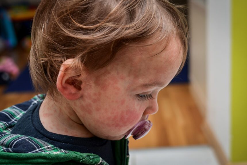 small child with pacifier, with measles rash on his face