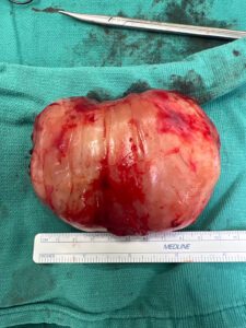 Grapefruit-sized tumor that was removed from Sierra's leg