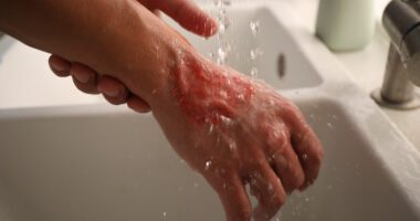A person cools a painful burn on the back of their hand under running water.