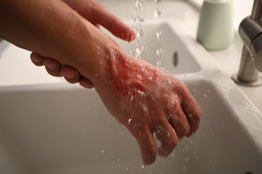A person cools a painful burn on the back of their hand under running water.